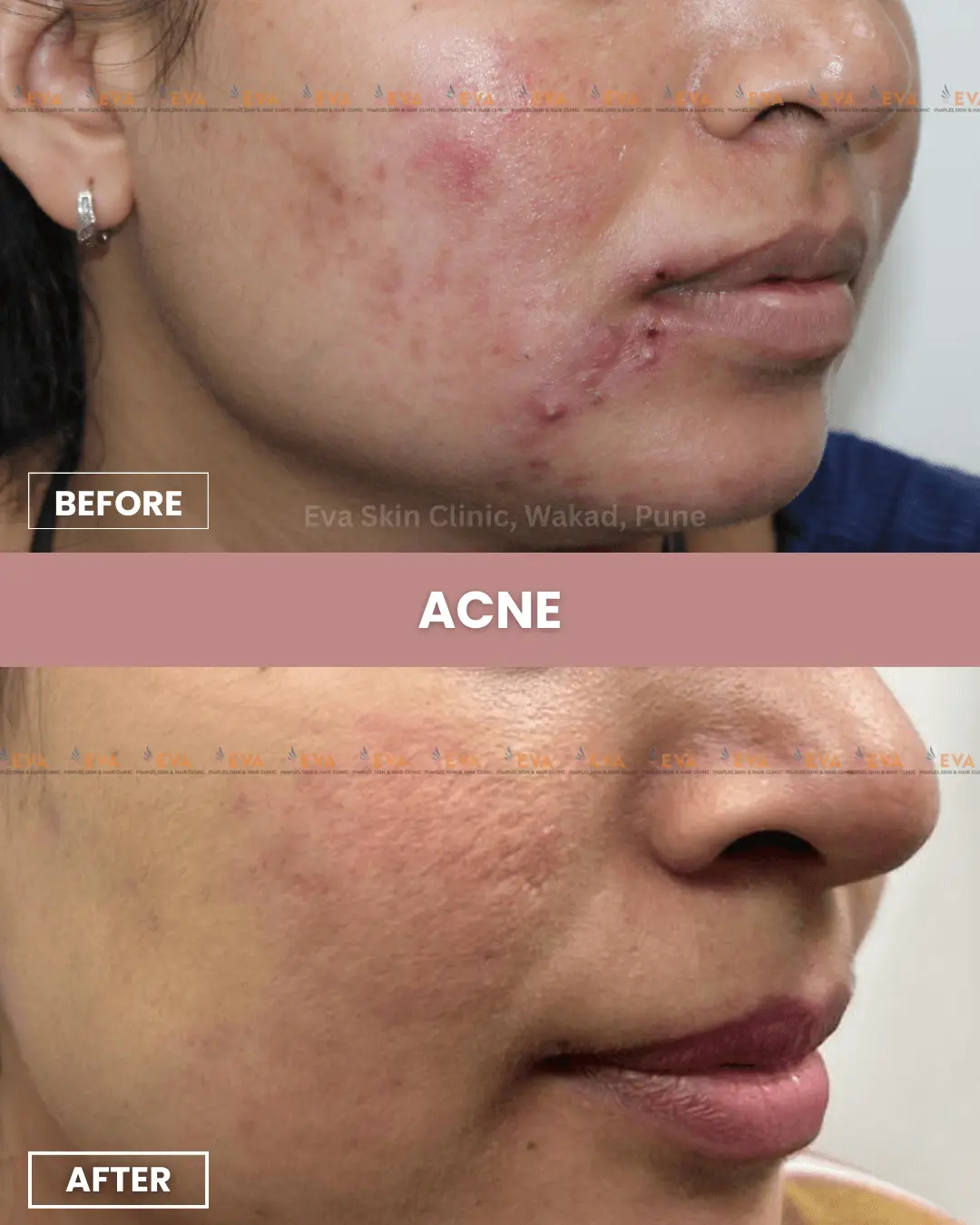 best-acne-treatment