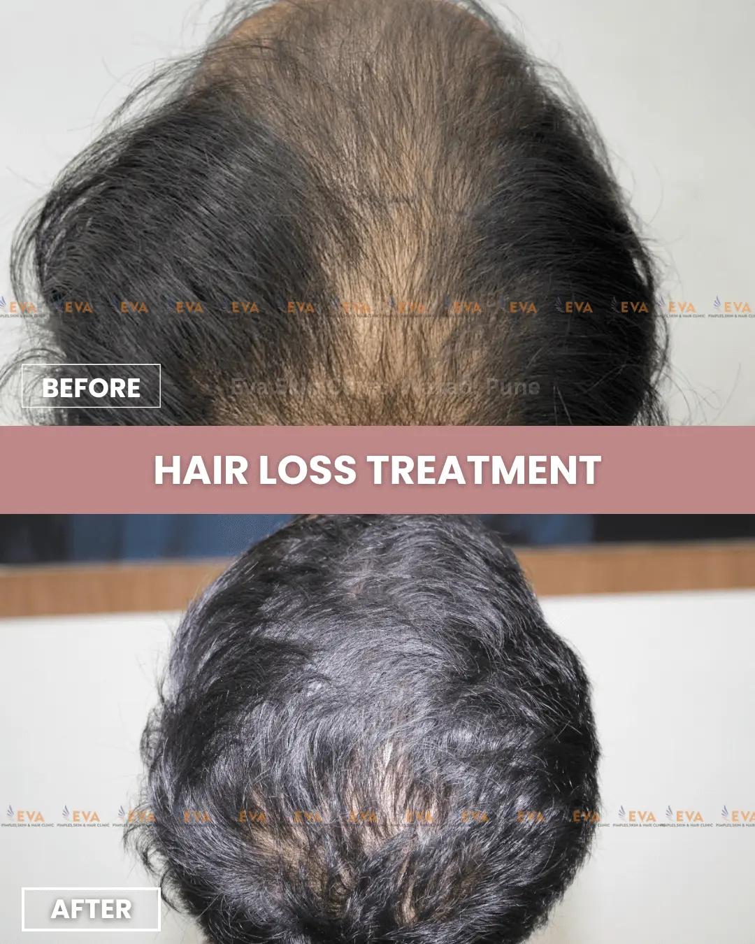 best-hair-results-treatment-in-pune