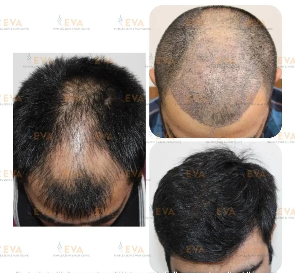 best-hair-transplant-results-FUE