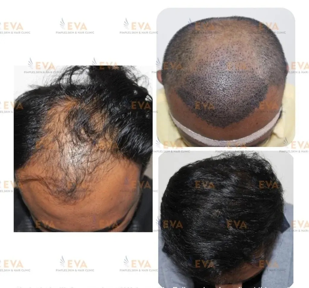 best-hair-transplant-results
