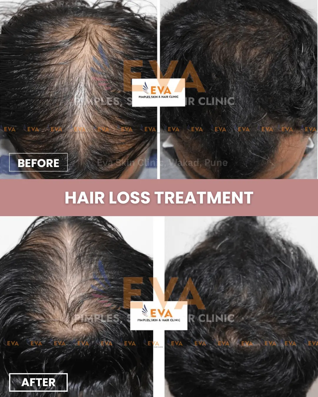 best-hair-treatment-results