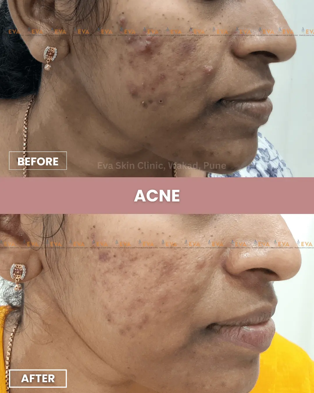 best-pimple-results-in-wakad-pune