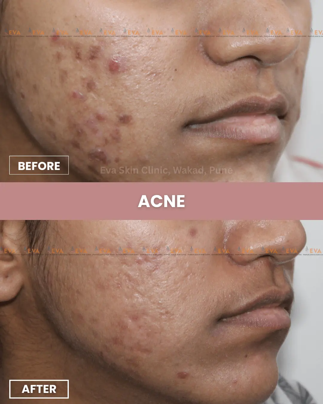 best-pimple-treatment-in-pune