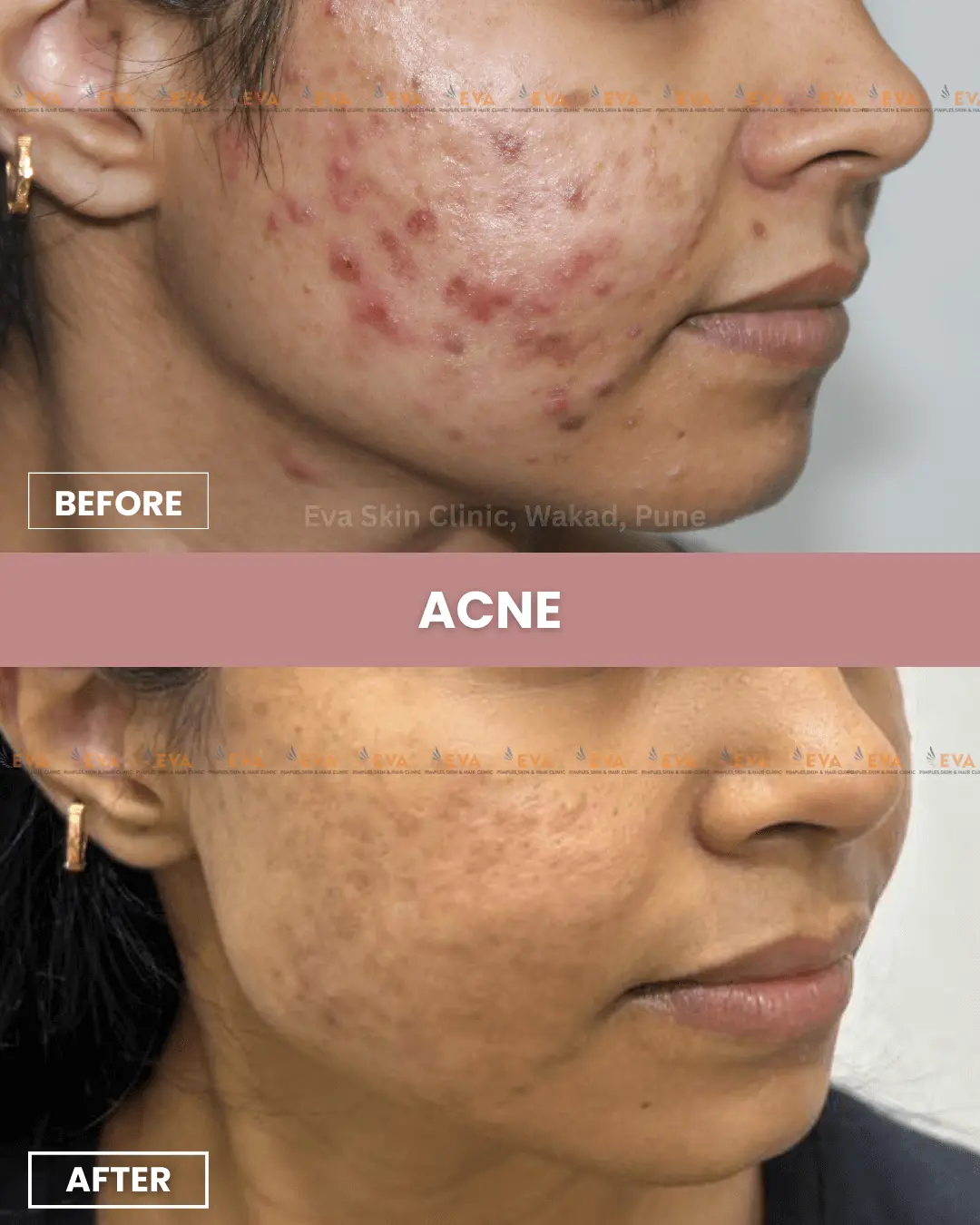 best-pimple-treatment