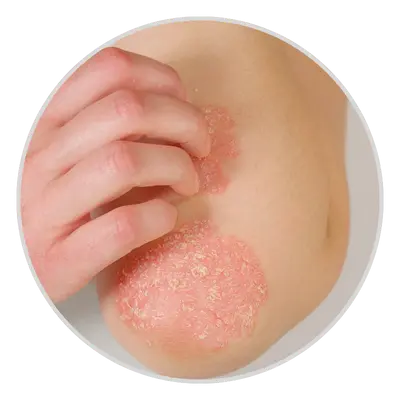 eczema treatment in pune