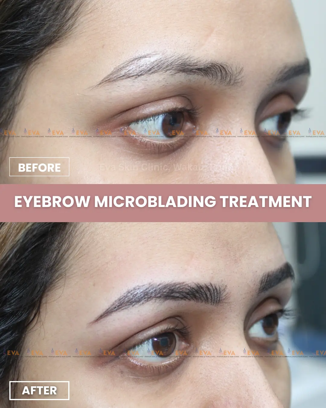 eyebrow-microblading-before-after-pune
