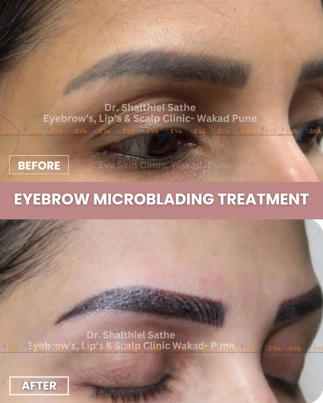 eyebrow-microblading-treatment