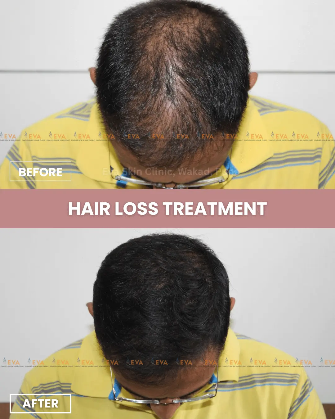 hair-loss-results-treatment