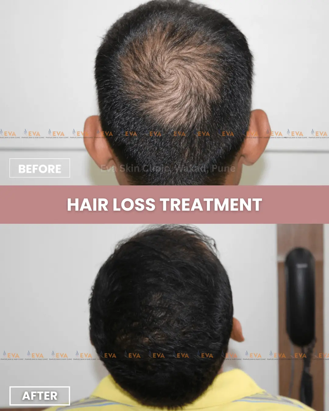 hair-loss results
