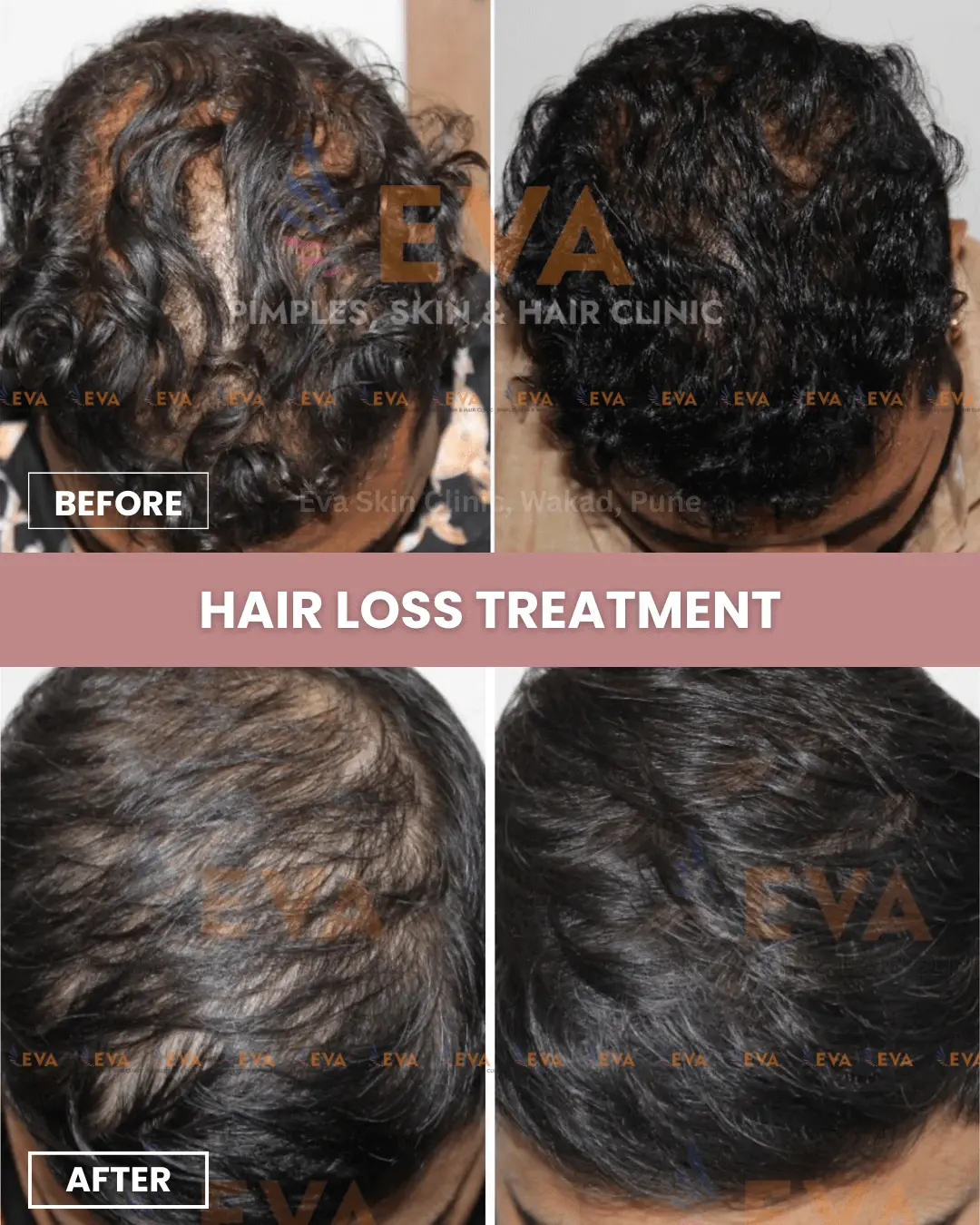 hair-treatment-in-pune