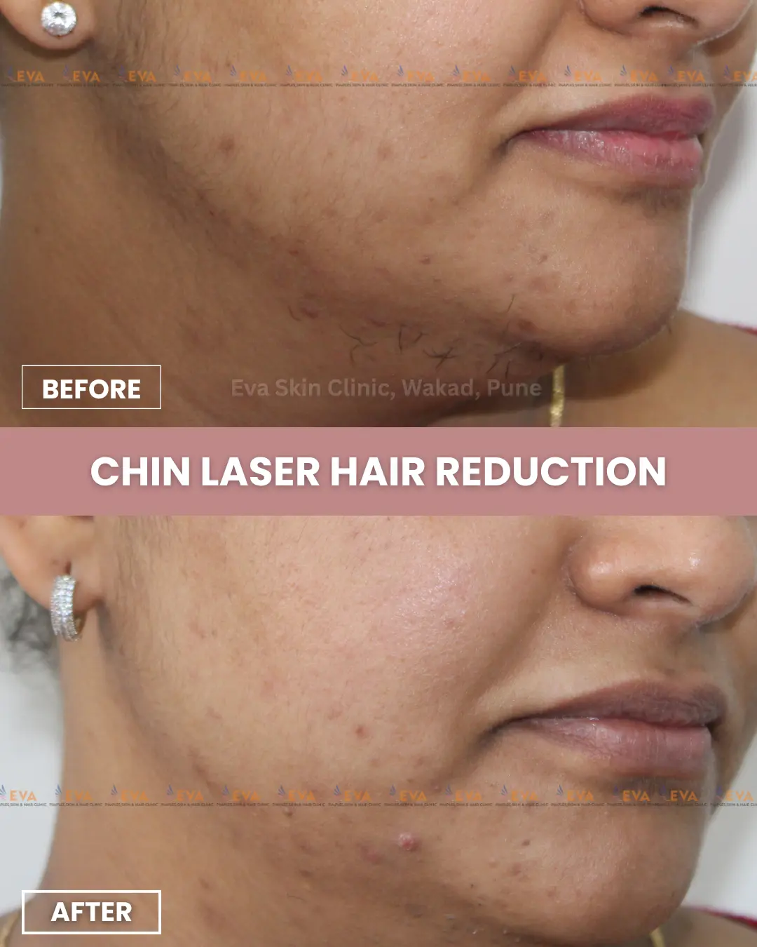 laser-hair-removal-before-after