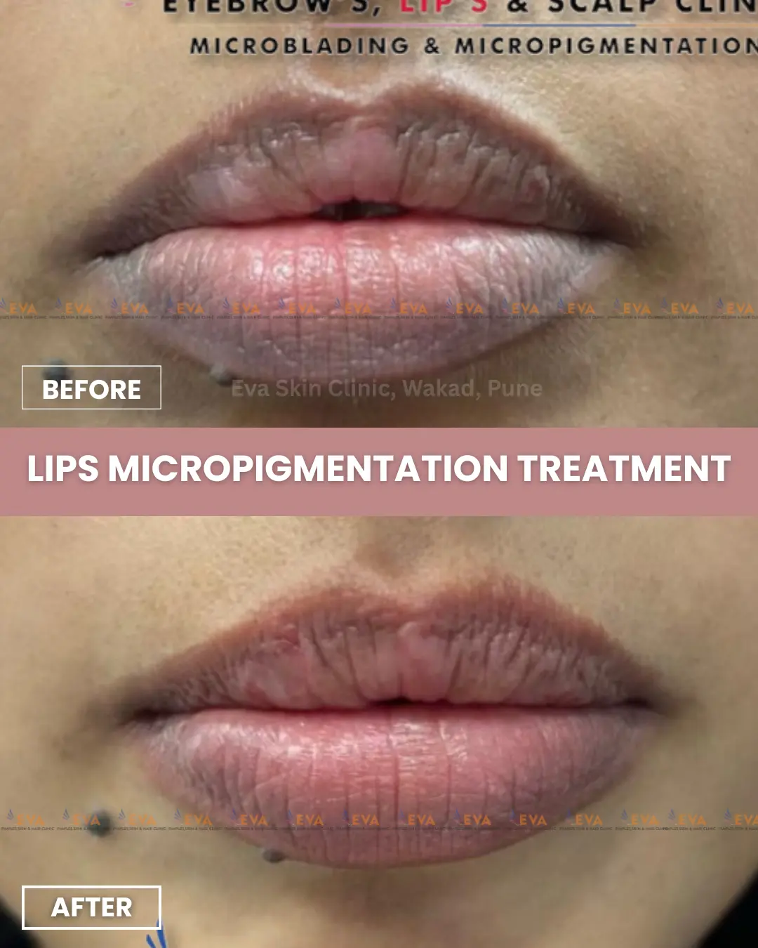 lips-micropigmentation-before-after-results-in-pune