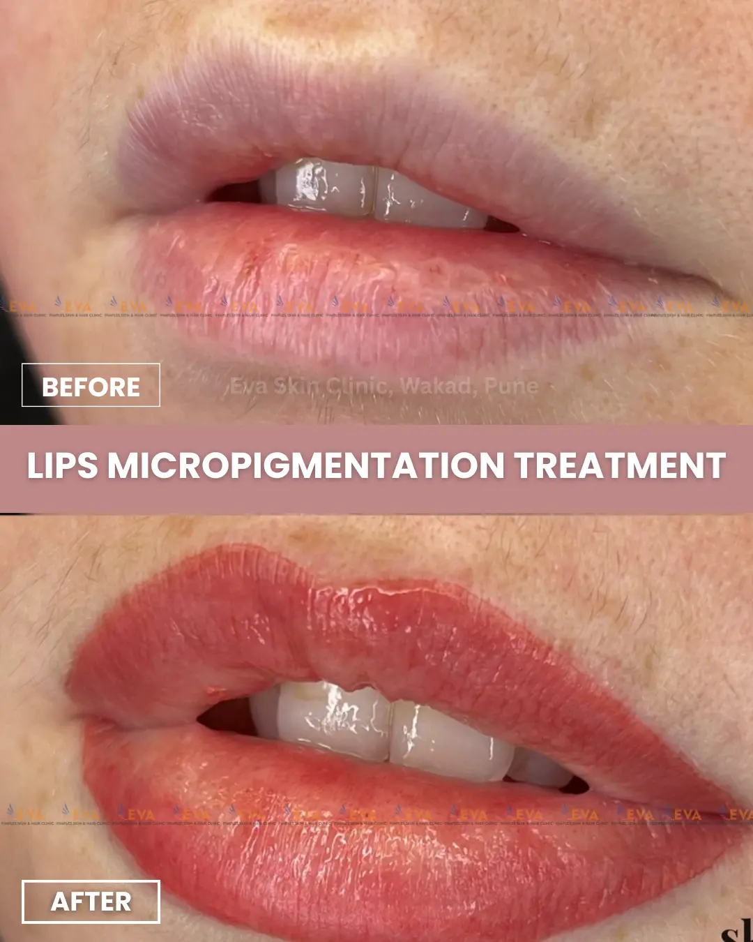 lips-micropigmentation-before-after-results