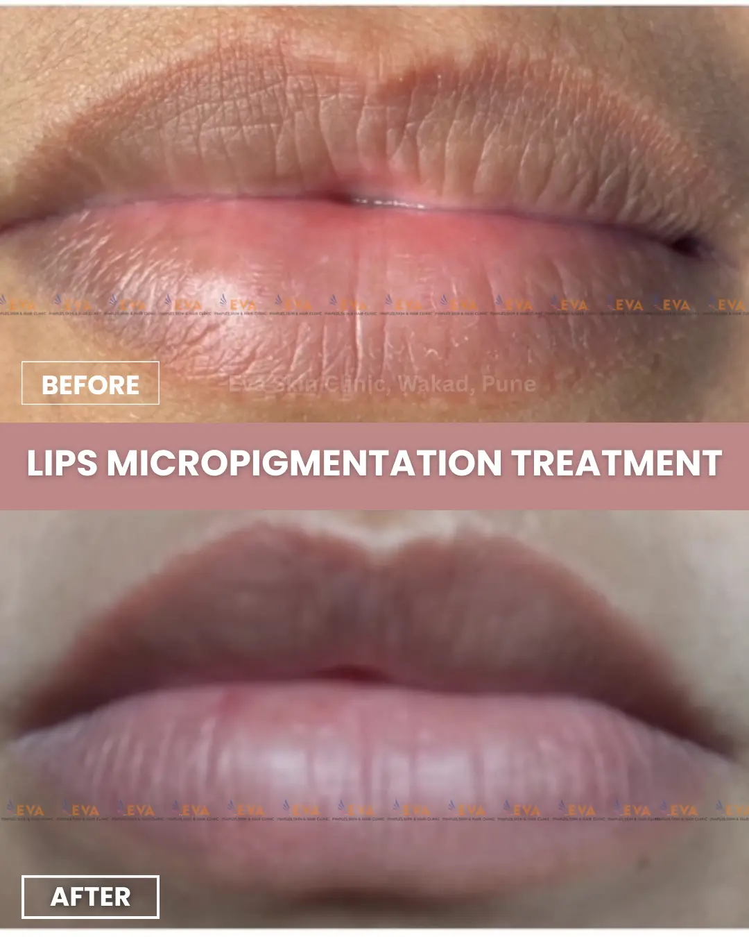 Lips micropigmentation