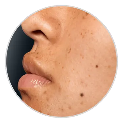 liver spots treatment in pune