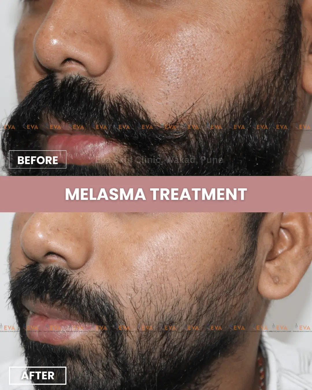 melasma-before-after