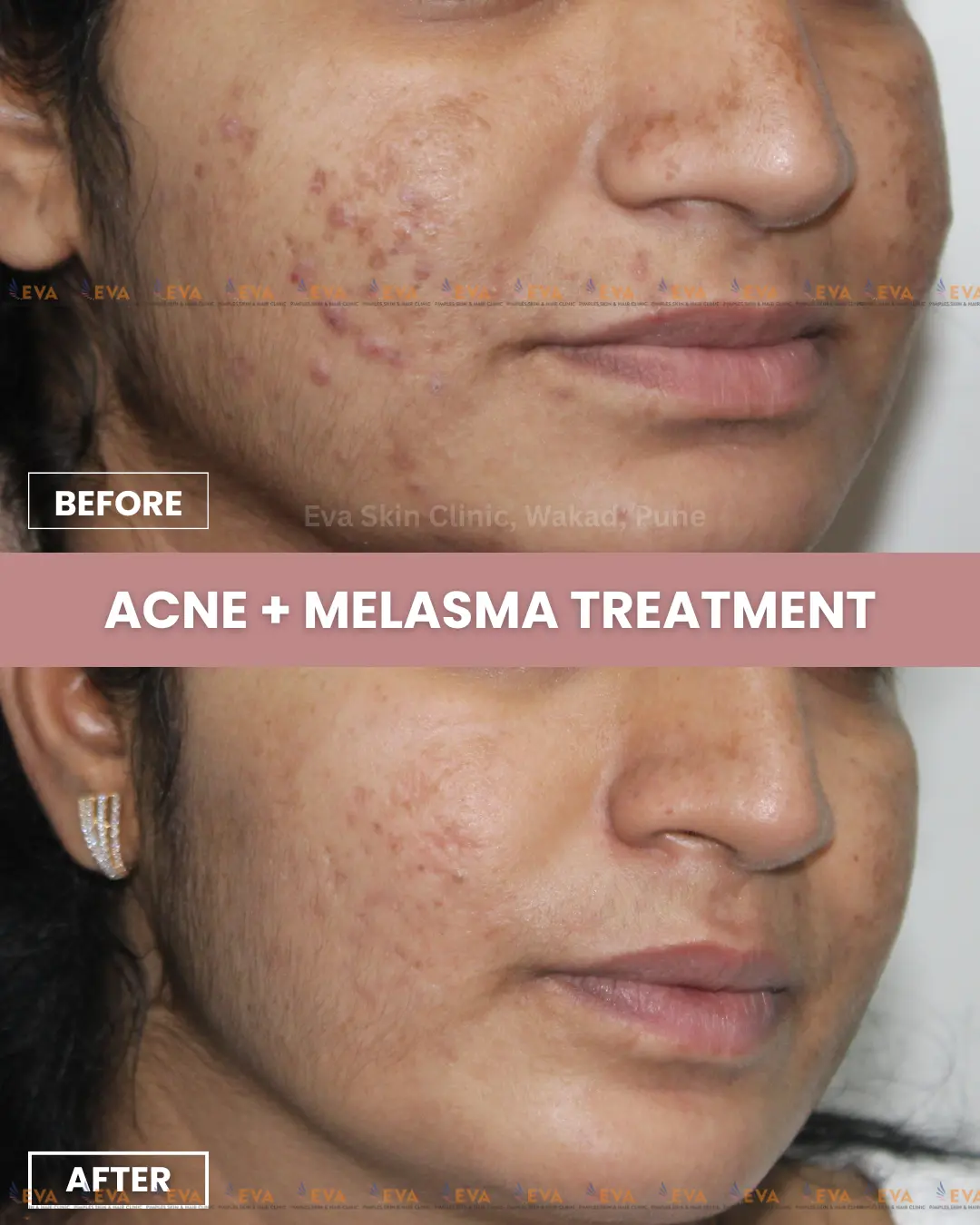melasma treatment