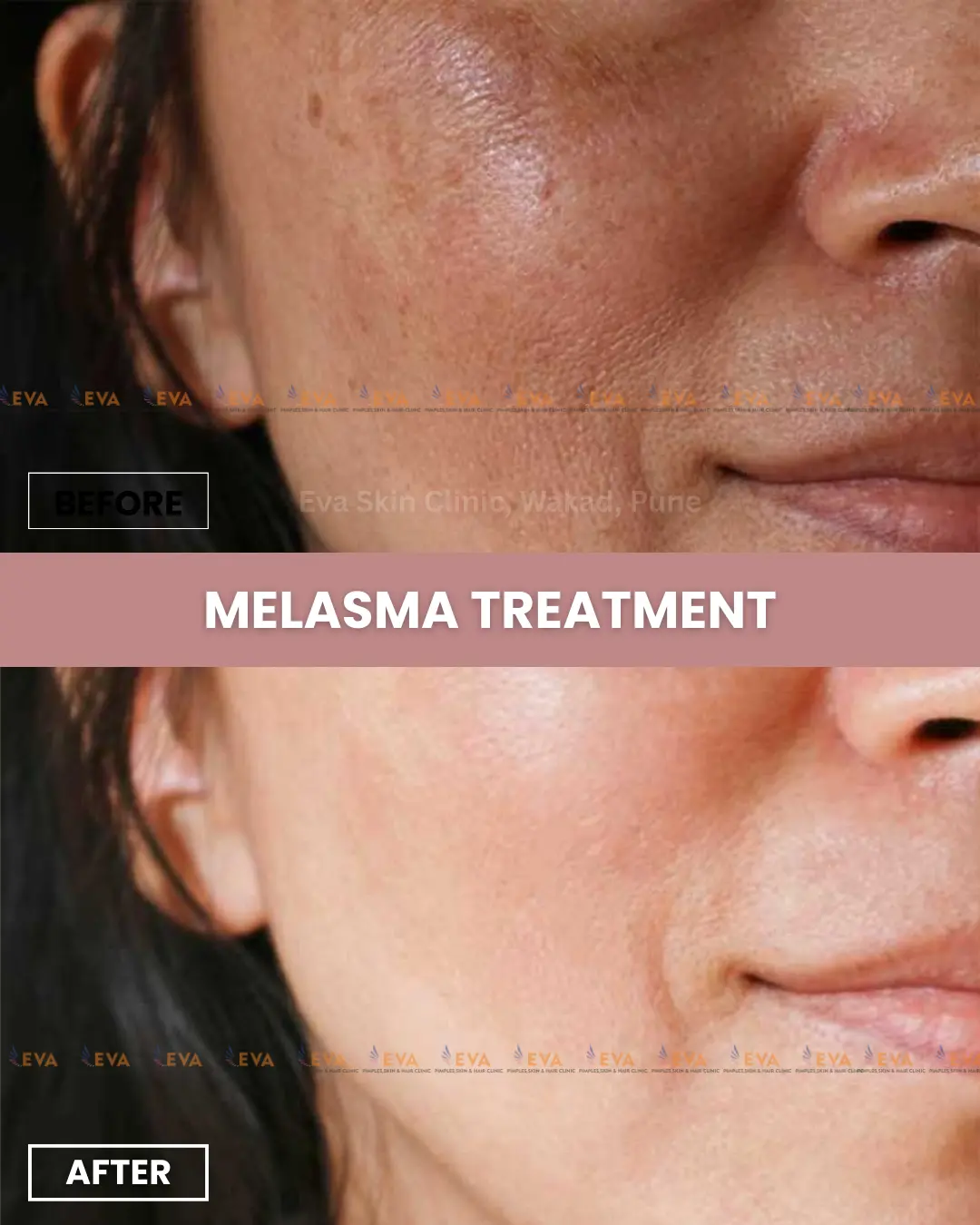 melasma-results