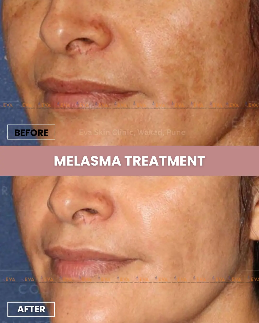 melasma-treatment-in-pune