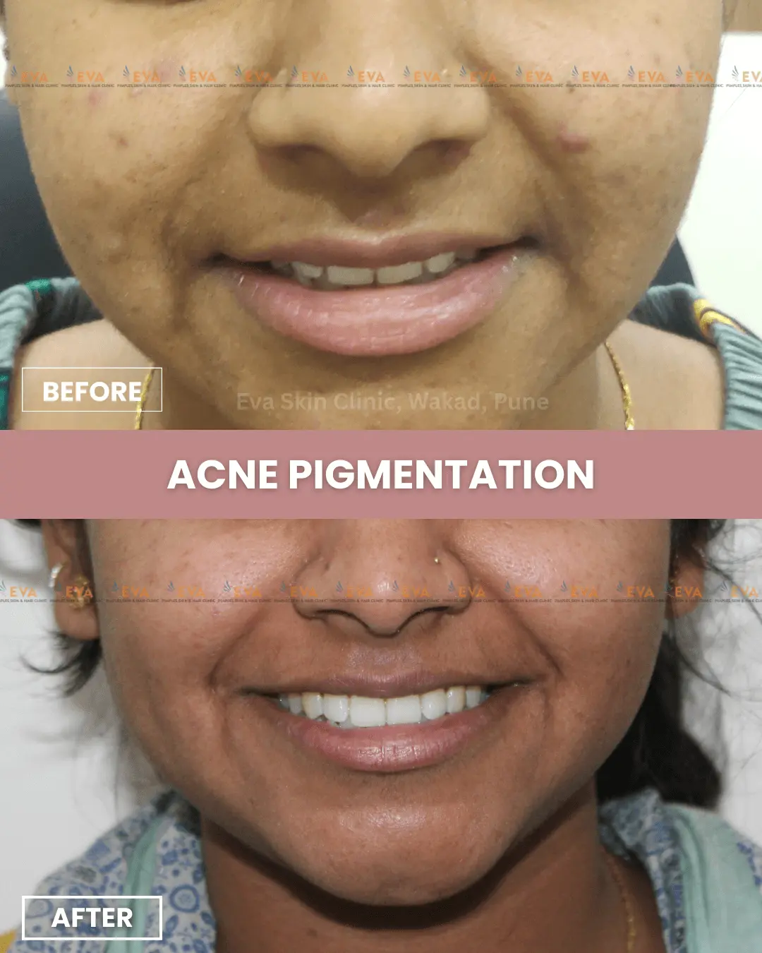 pimple-results-in-pune