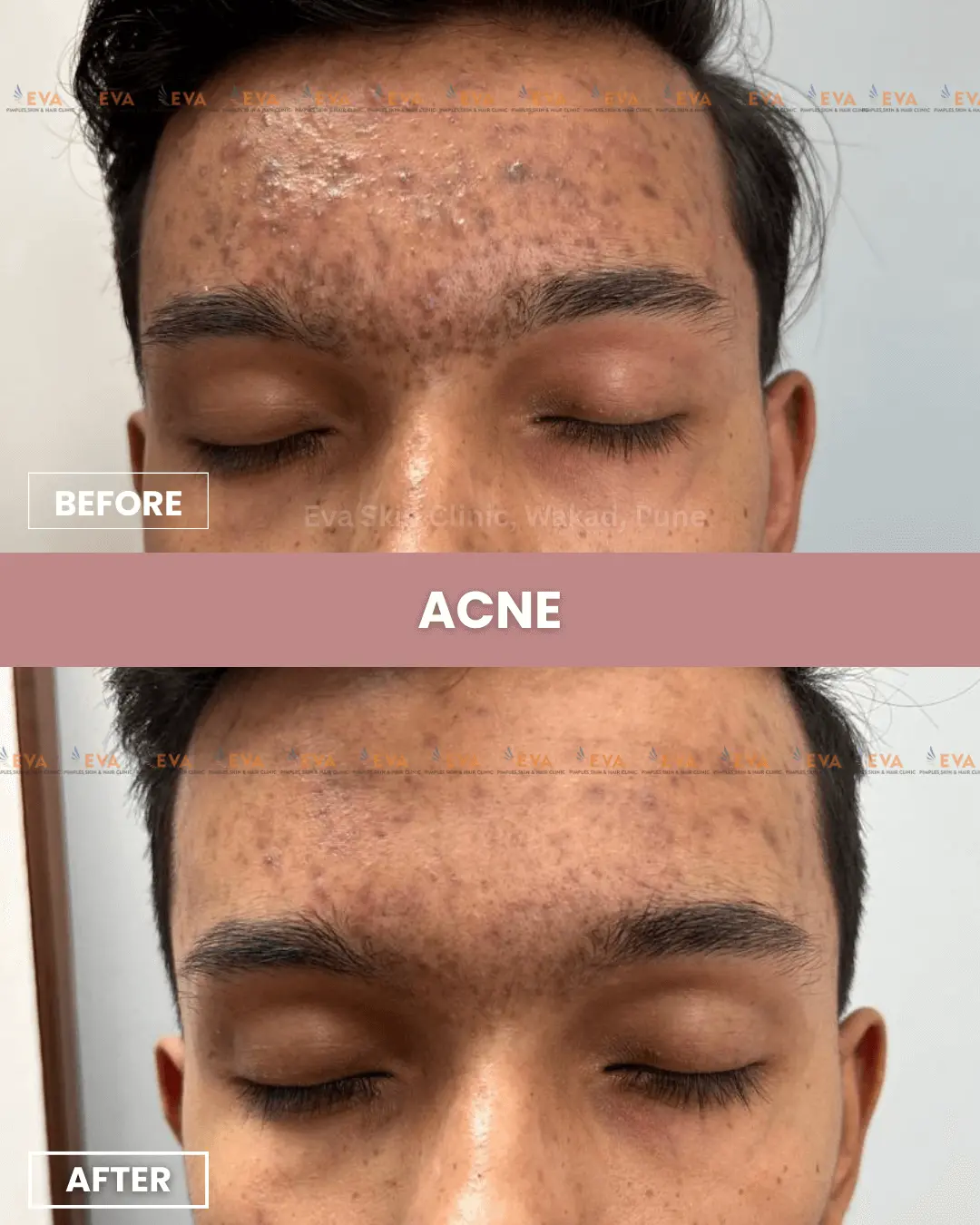 pimple-treatment-by-dermatologist