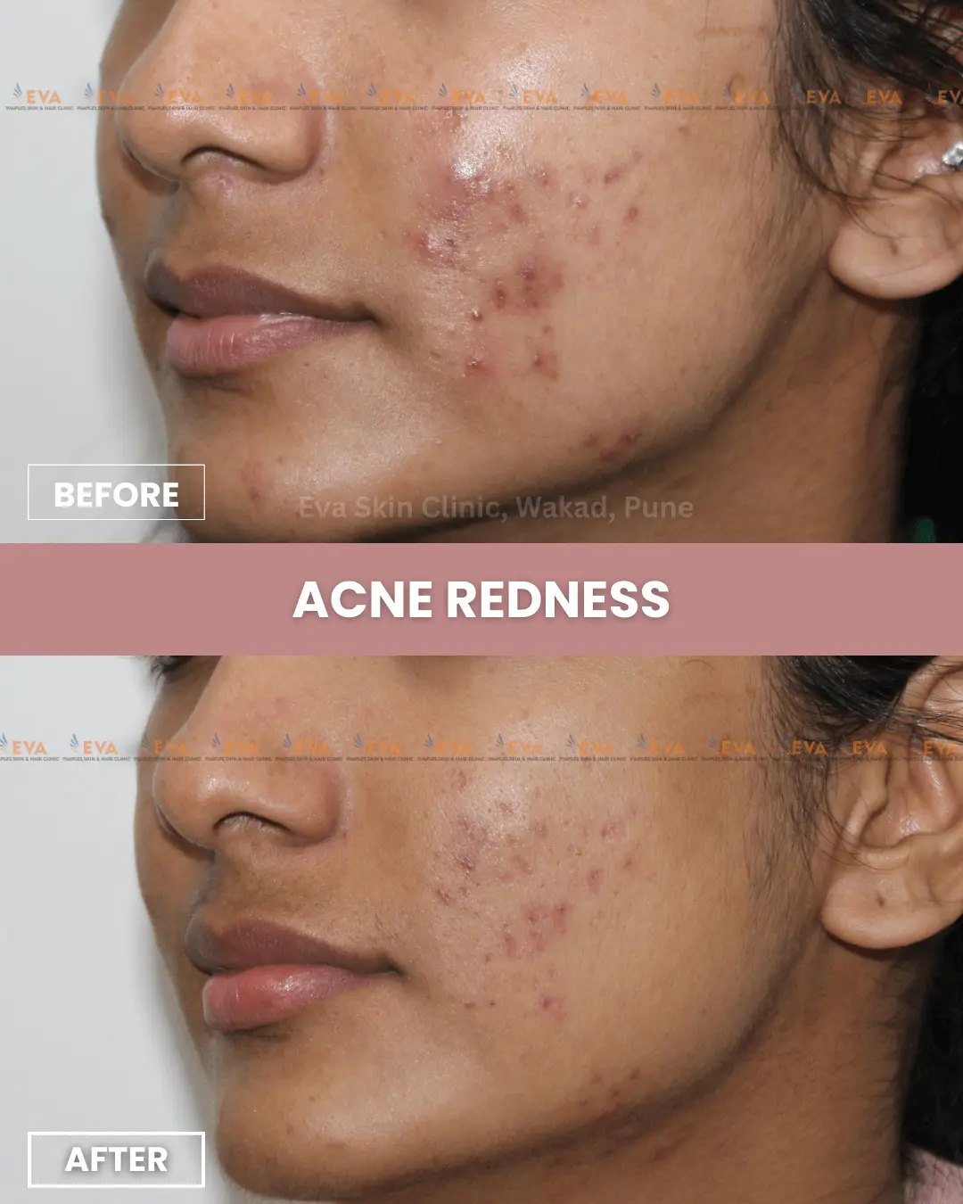 results-acne-treatment