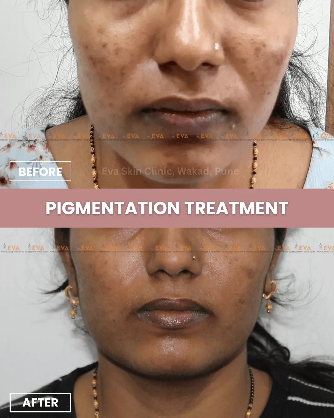 skin-pigmentation-before-after-results