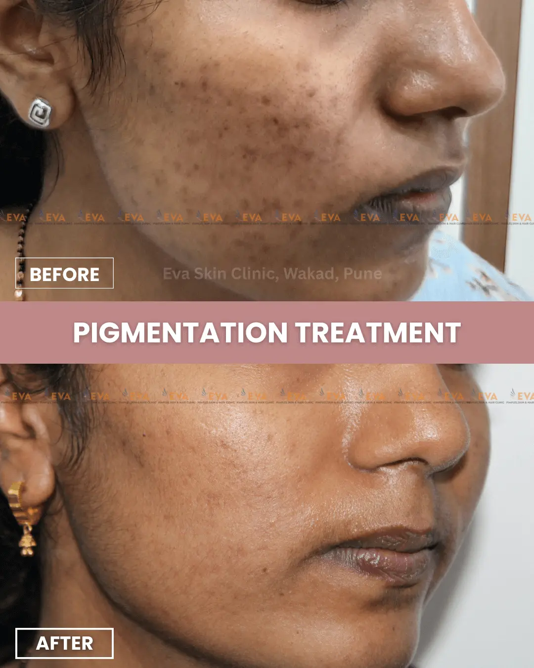 acne pigmentation