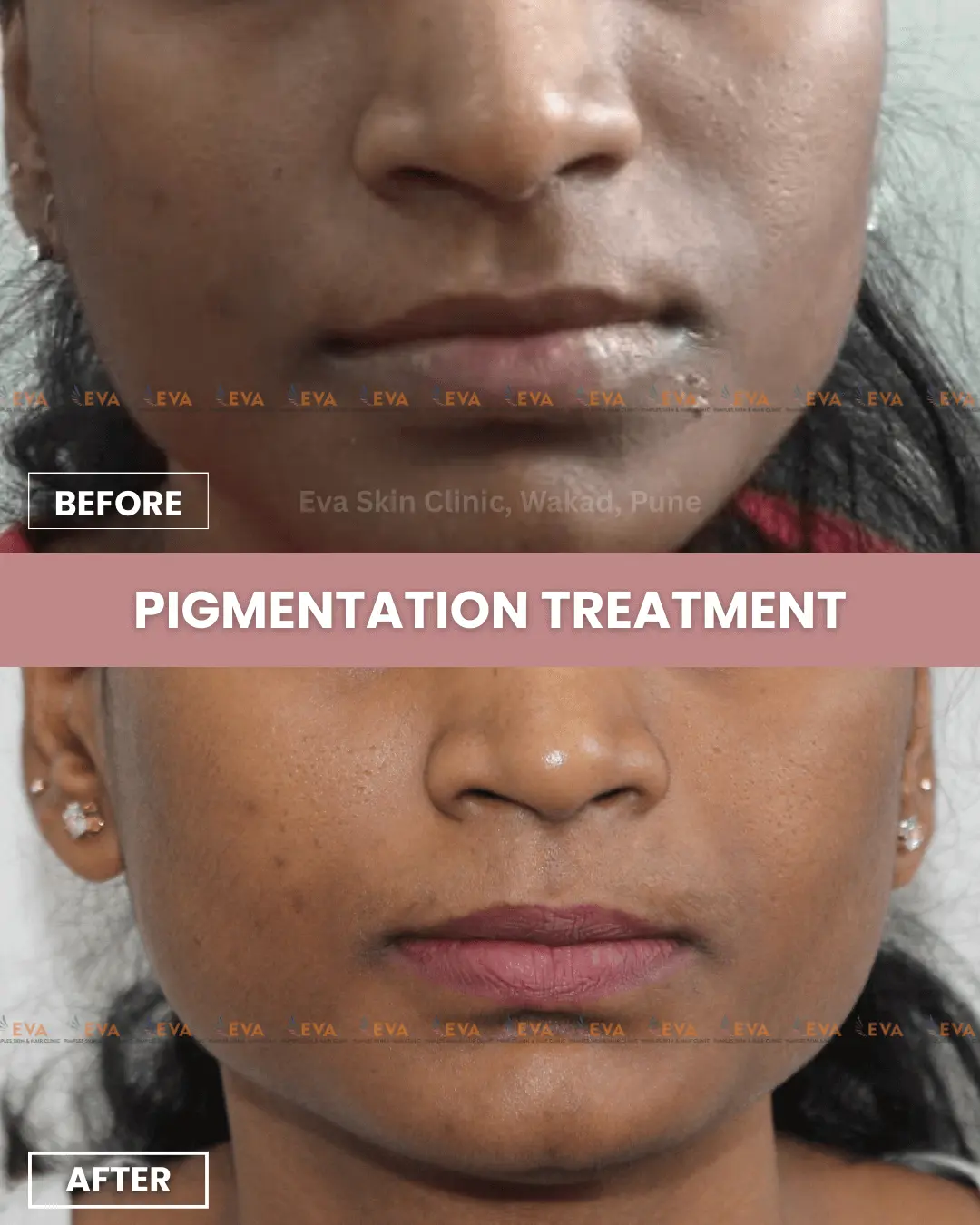 skin-pigmentation-results
