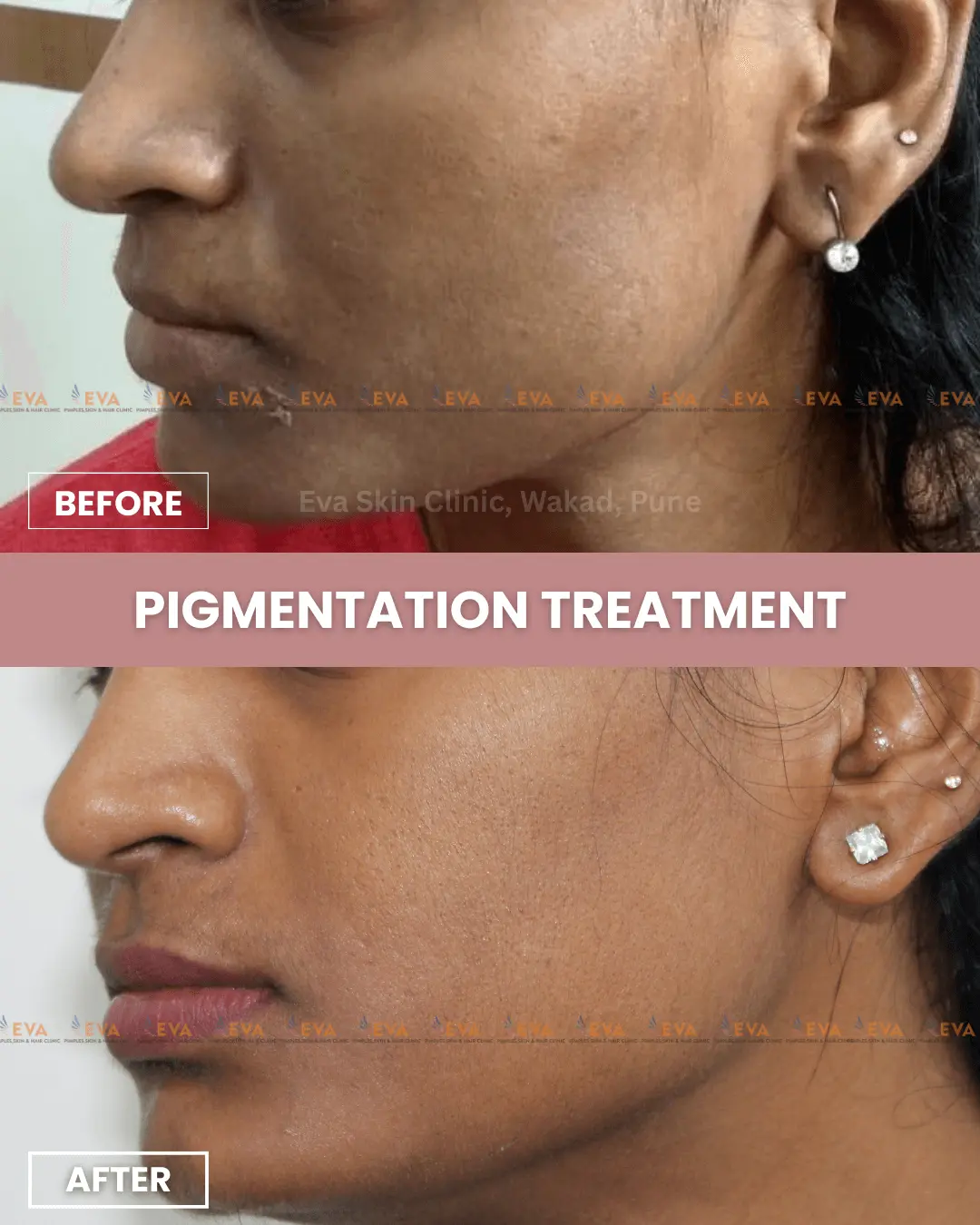 skin-pigmentation-treatment