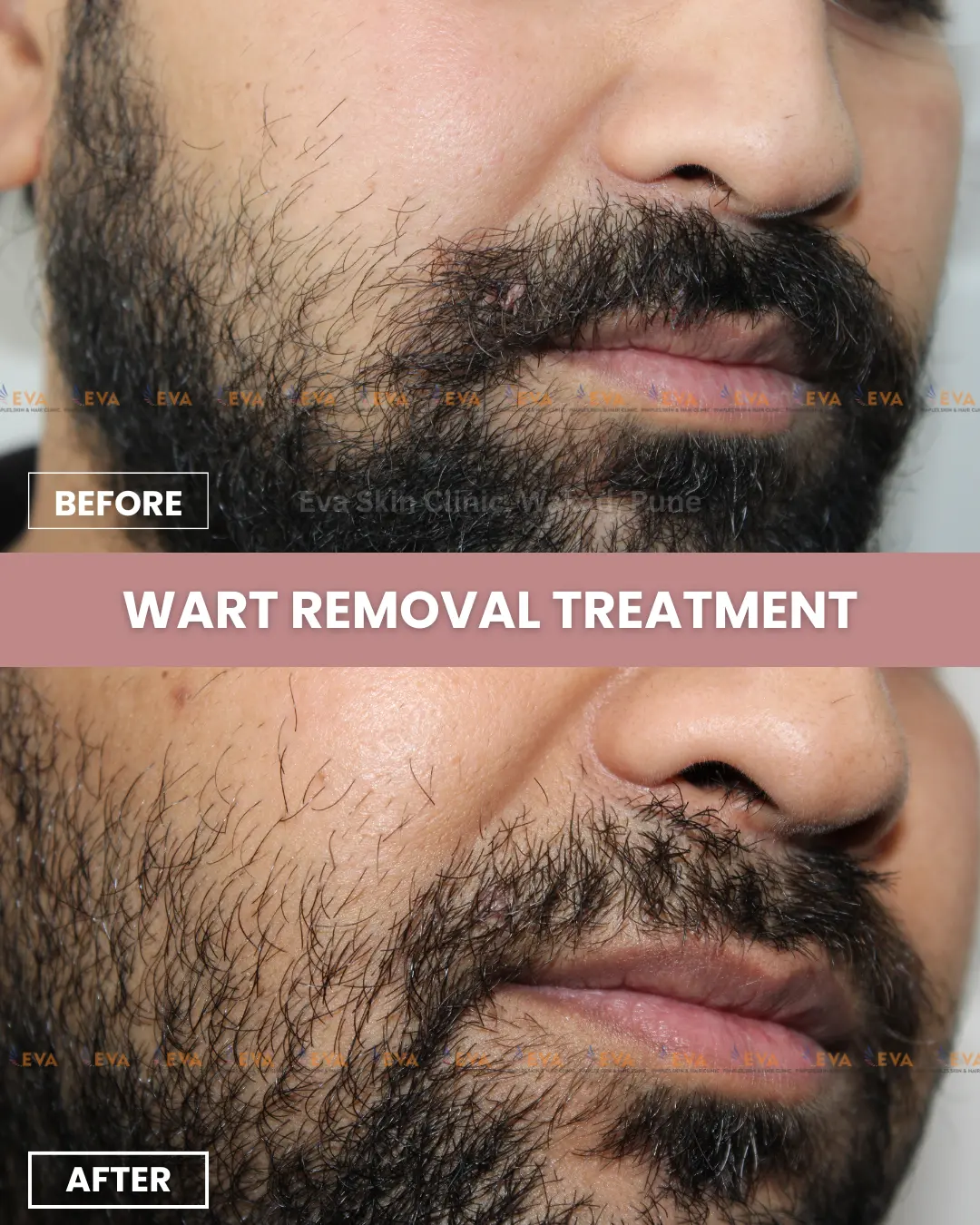 skin tags and wart
