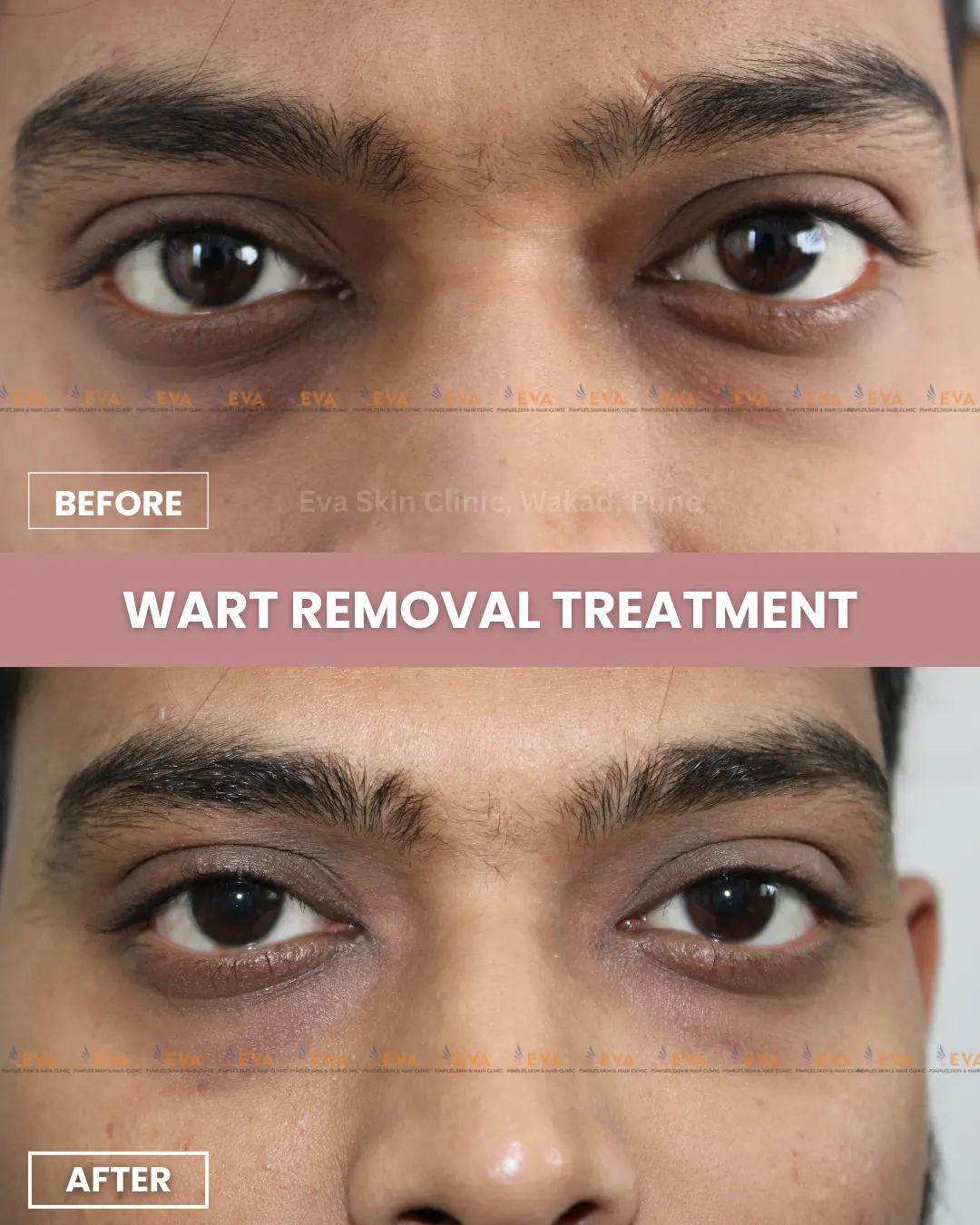skin-tag-removal-results-in-pune
