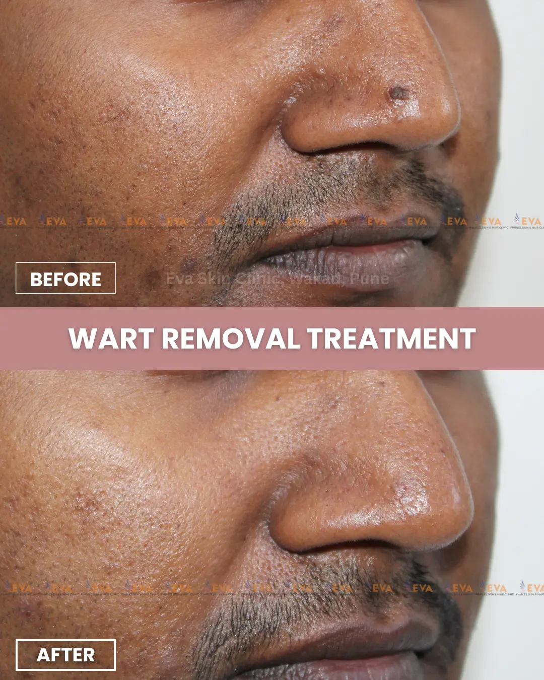 skin-tag-removal-results