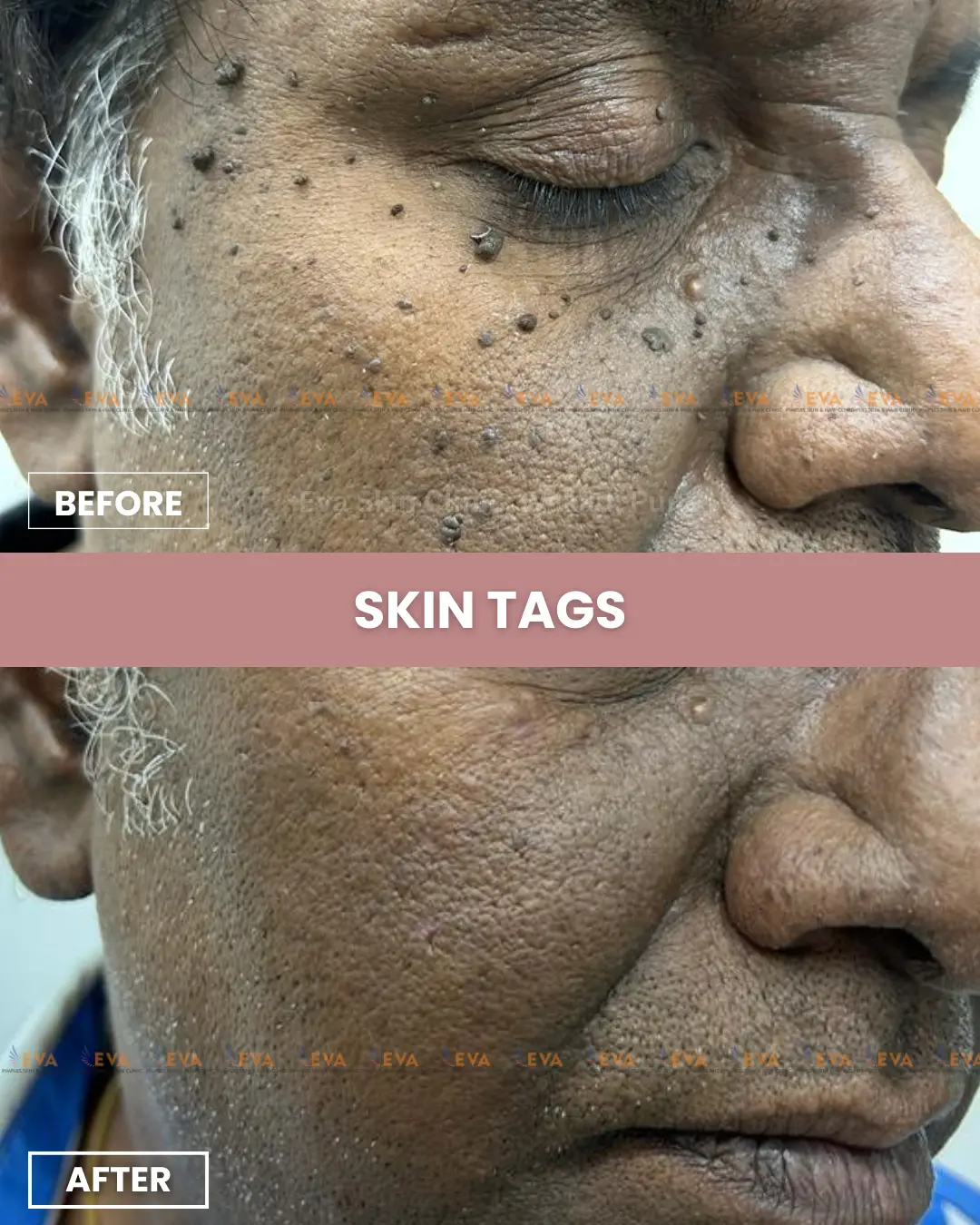 skin-tag-results-in-pune