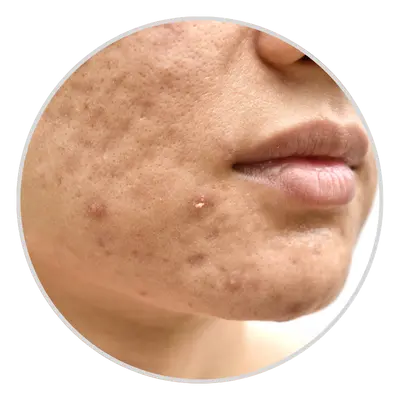 Acne Scars