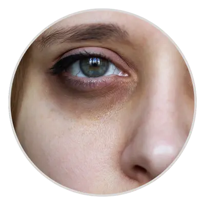 Darkened Skin Beneath the Eyes