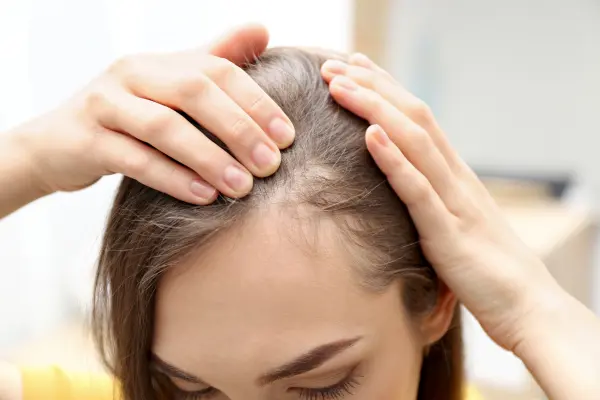 Female Pattern Hair Loss