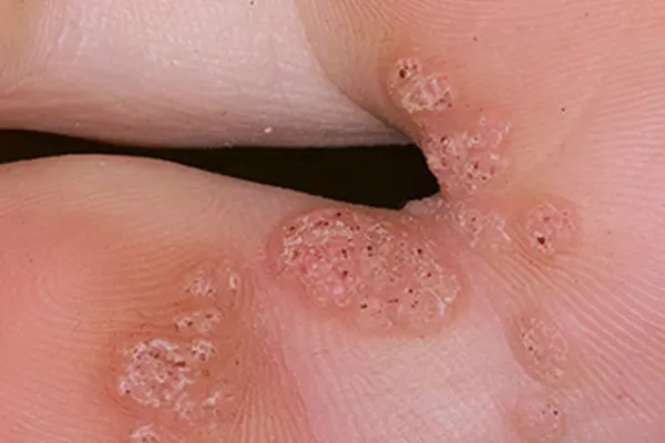 HPV Infection