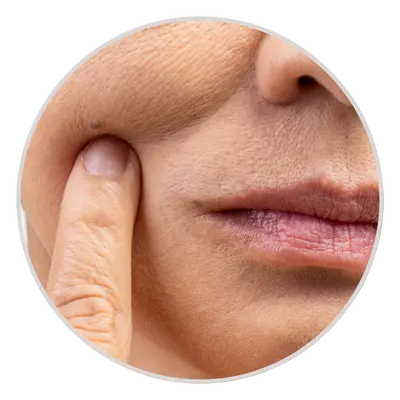 Loose Skin