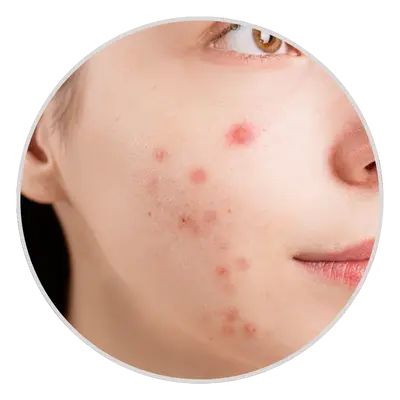 Persistent Acne or Acne Scars