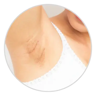 Post-Inflammatory Hyperpigmentation (PIH)