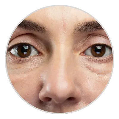 Premature Aging