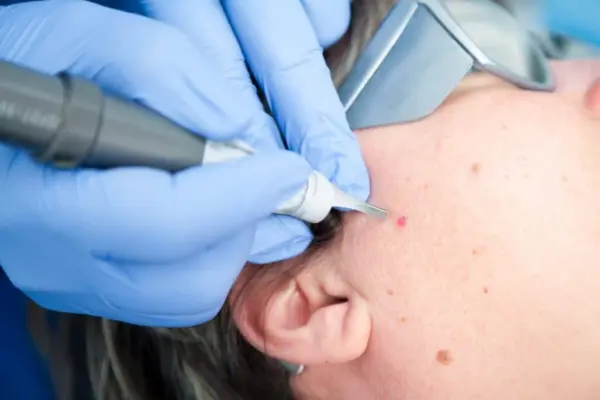 skin warts removal