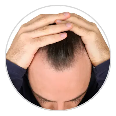 Receding Hairline