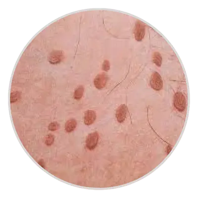 Small & Flat Skin Tags