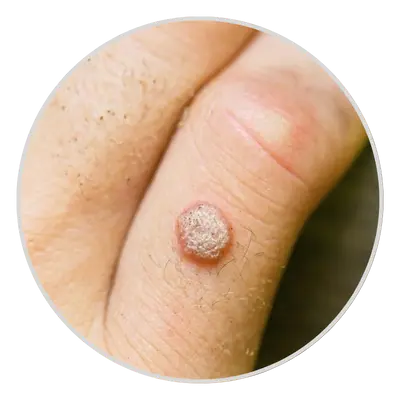 Small, Grainy Bumps