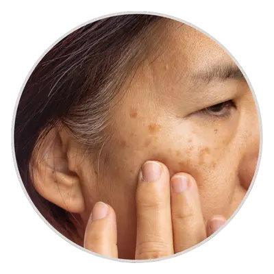 Stubborn Pigmentation