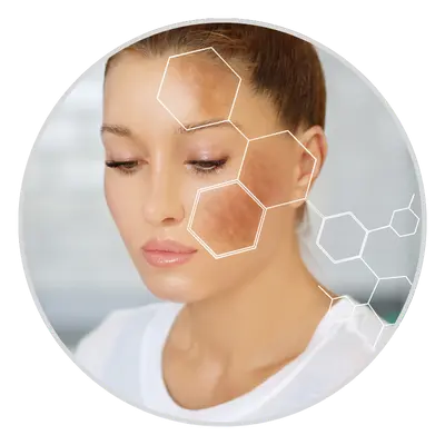 hyperpigmentation