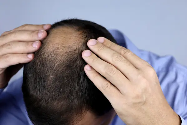 male pattern baldness