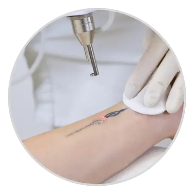 nd yag laser treatment for tattoo removal